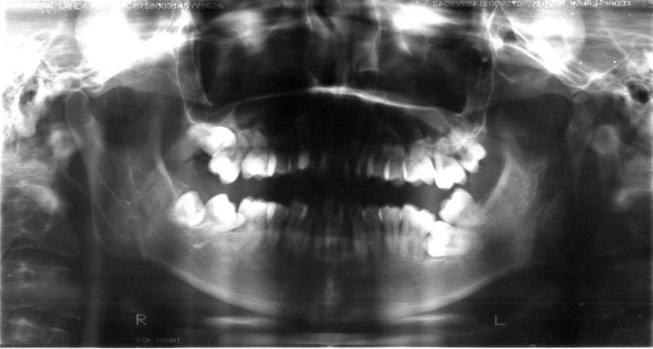 野田矯正歯科クリニック・重積状埋伏歯の保存療法