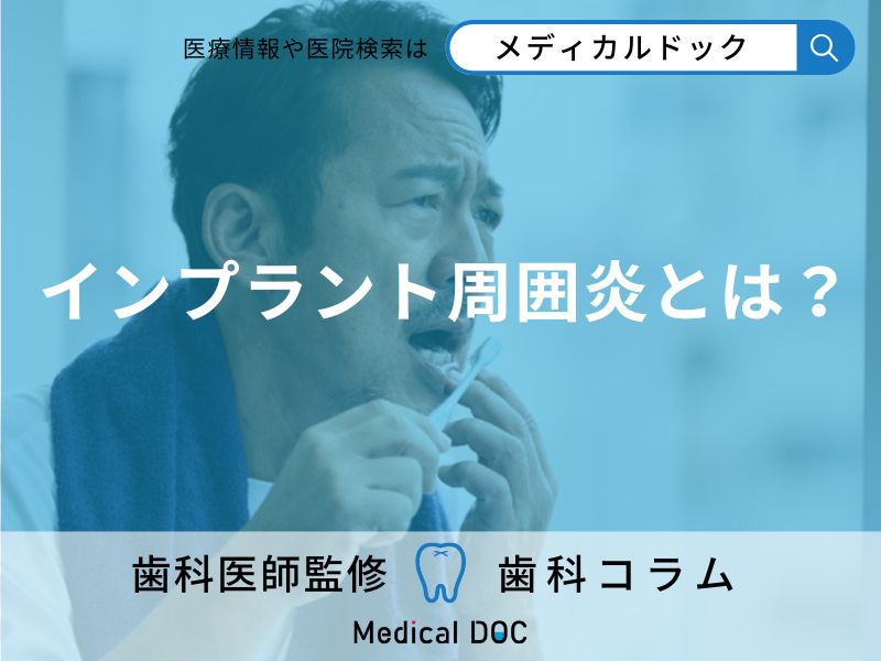 せっかく入れたインプラントがグラグラに? 治療後に起こる「インプラント周囲炎」とは?