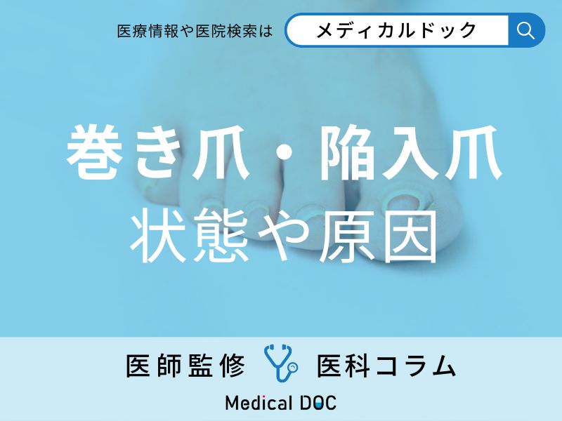 巻き爪・陥入爪(かんにゅうそう)ってどんな状態? どうして起こるの?