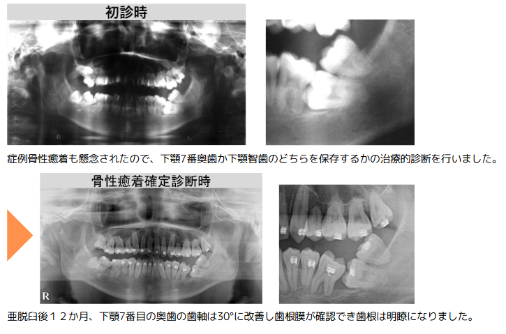 野田矯正歯科クリニック・重積状埋伏歯の保存療法・Before～After・レントゲン画像①