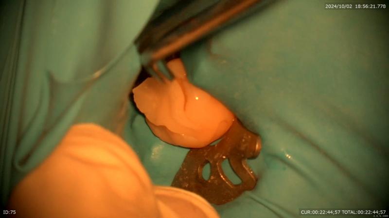 西新宿五丁目デンタルクリニック1Dayセラミックbefore