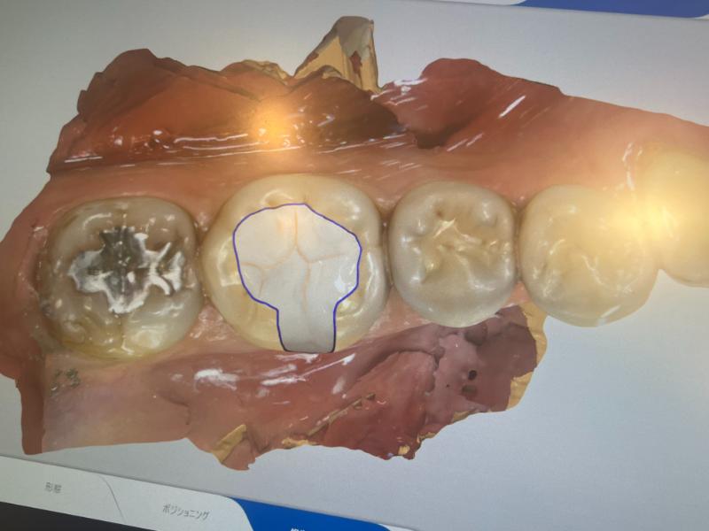 西新宿五丁目デンタルクリニック1Dayセラミックbefore