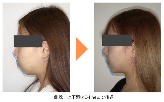 野田矯正歯科クリニック・小臼歯抜歯治療の症例紹介・Before～After・顔貌横