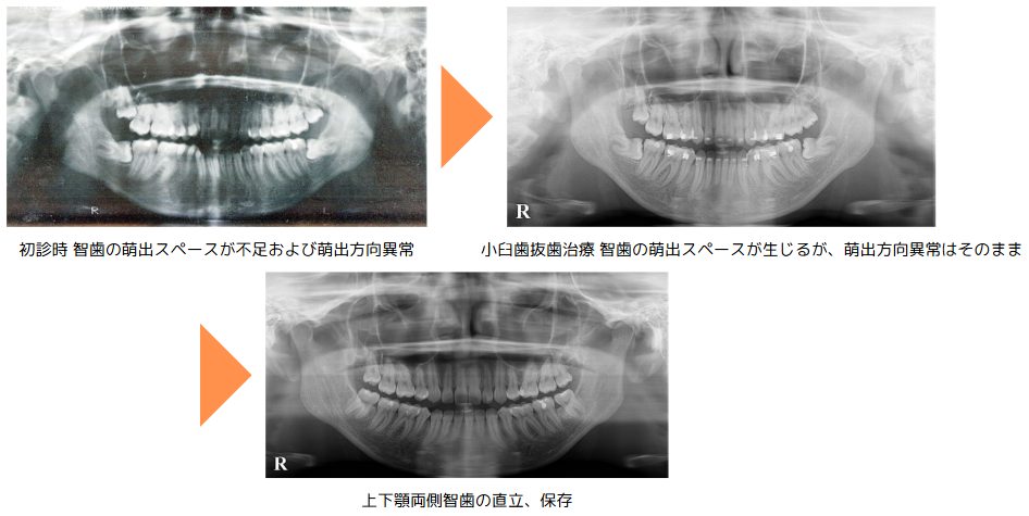 野田矯正歯科クリニック・小臼歯抜歯治療の症例紹介・Before～After・顔貌レントゲン