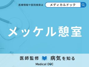 メッケル憩室