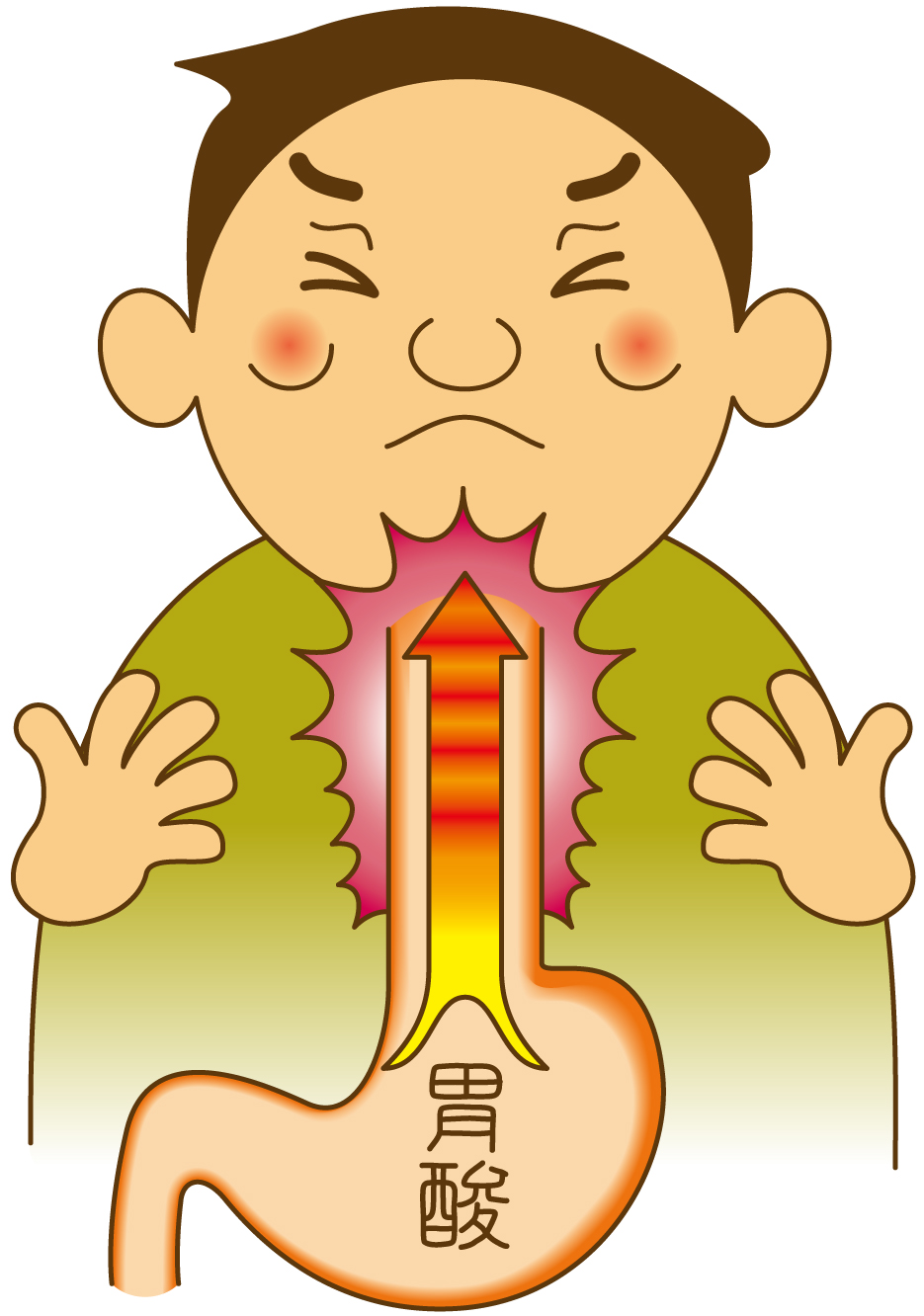 逆流性食道炎の概要