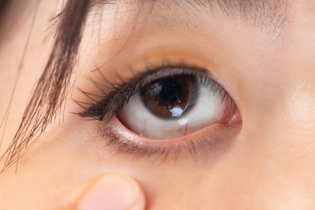 片目だけ結膜炎になる理由と割合