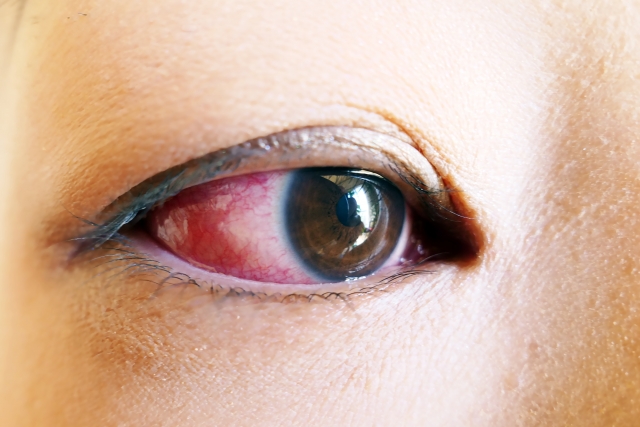 結膜炎の基礎知識