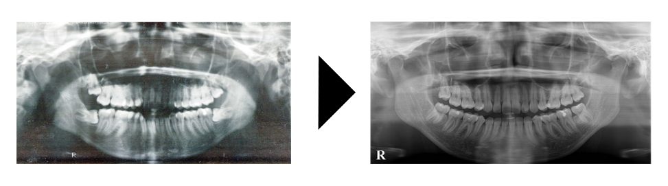 野田矯正歯科クリニック・小臼歯抜歯治療の症例紹介