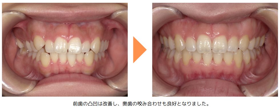 野田矯正歯科クリニック・小臼歯抜歯治療の症例紹介・Before～After・正面