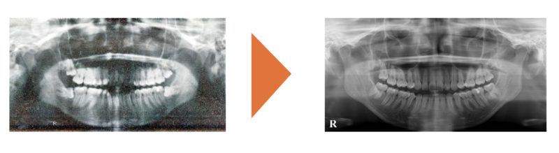 野田矯正歯科クリニック・小臼歯抜歯治療の症例紹介・Before～After・口腔内上