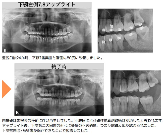 野田矯正歯科クリニック・重積状埋伏歯の保存療法・Before～After・レントゲン画像②