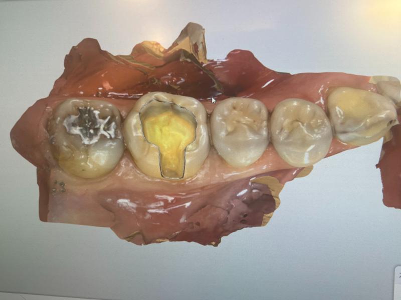 西新宿五丁目デンタルクリニック1Dayセラミックbefore