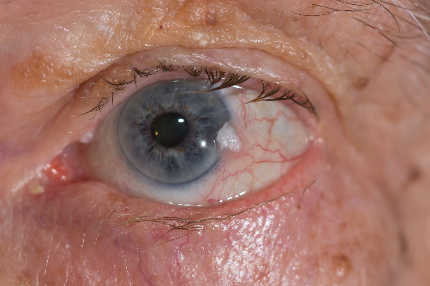 白内障ってどんな病気？