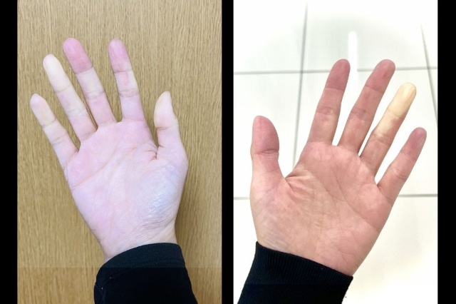 見た目ではわからない体の中のどこかで炎症が起き、痛みを感じる