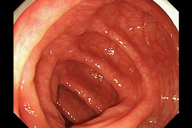 大腸内視鏡検査の基本とわかる病気について