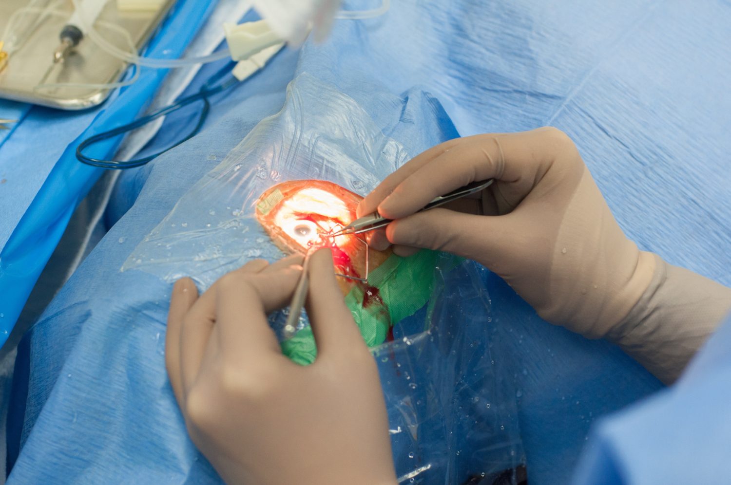 眼瞼下垂の治療法