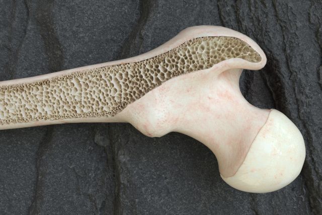 骨粗しょう症とは?