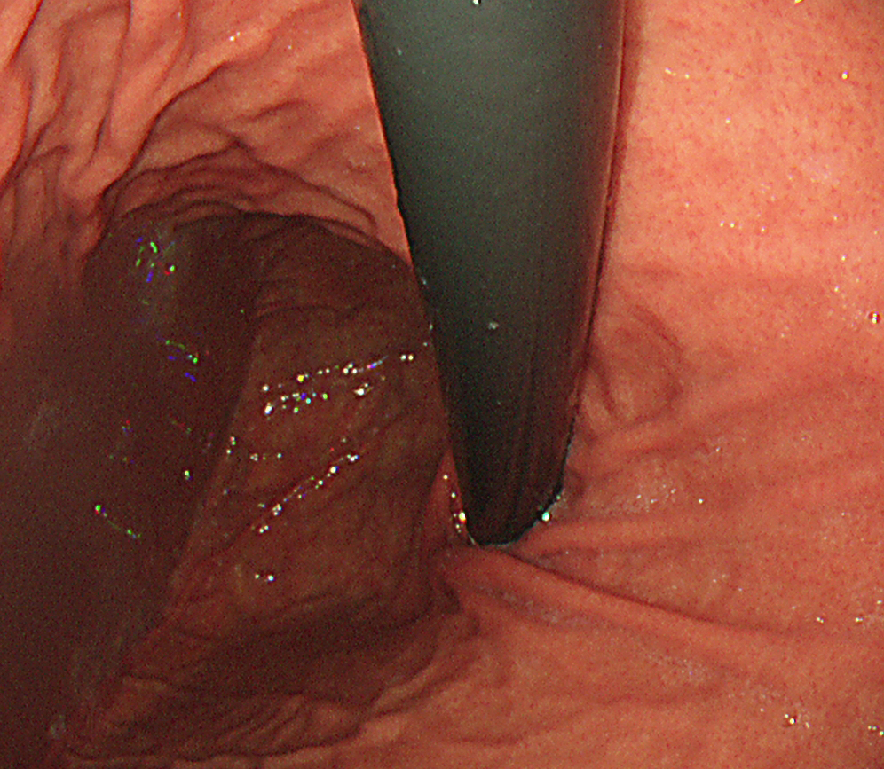 ピロリ菌の感染とリスクについて