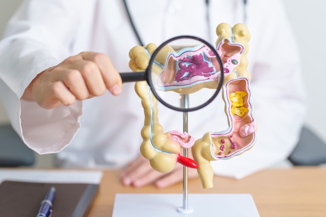 大腸CTはがんの早期発見に有効?