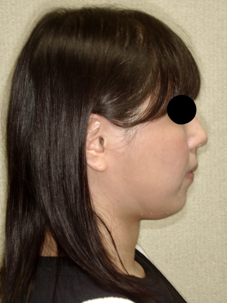 坂井歯科・矯正歯科・ワイヤー矯正の症例紹介②・before・横顔