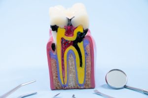 歯髄炎の症状とは？歯髄炎の原因やセルフチェック方法、歯科医院での治療方法を解説