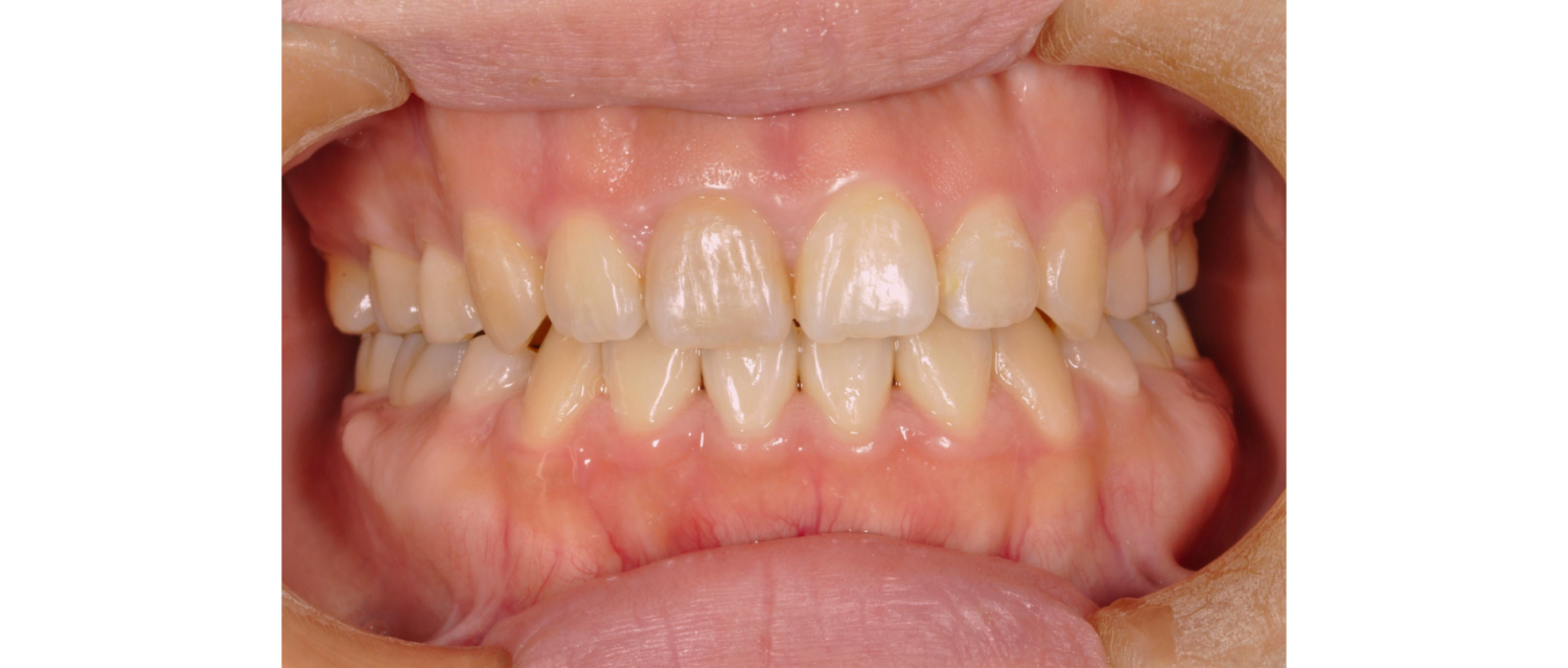 はらだ歯科クリニック ワイヤー矯正① after