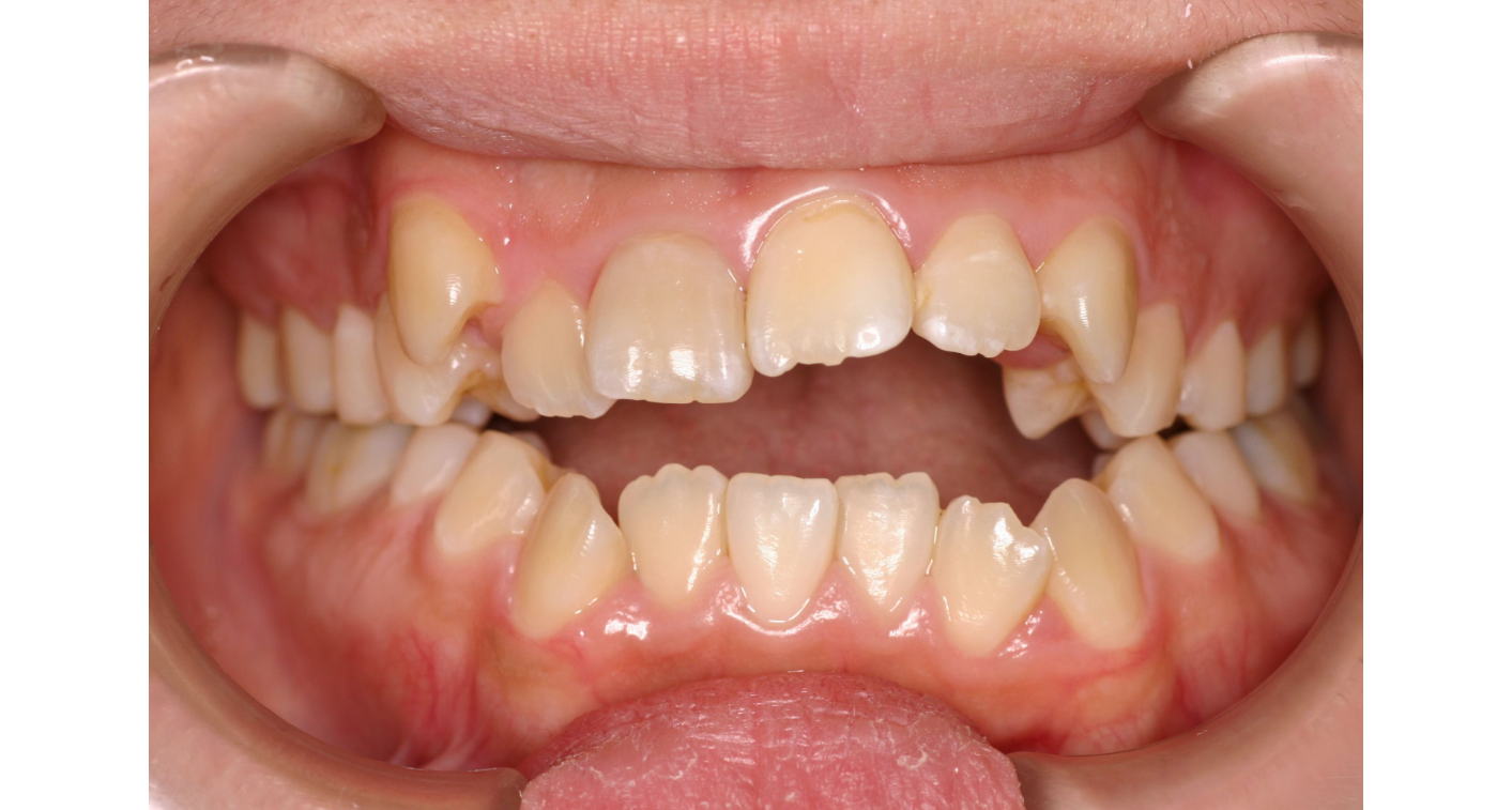 はらだ歯科クリニック ワイヤー矯正① before