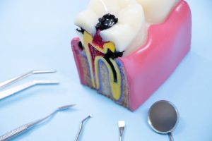 歯根端切除の術後はどのようなケアが必要？治療後の注意点やトラブルへの対応方法も解説