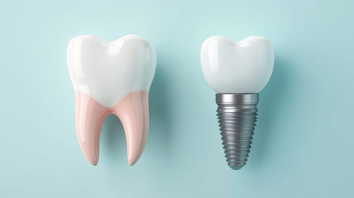インプラント治療の概要