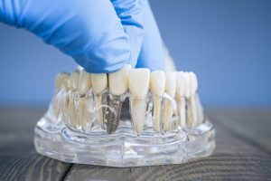 インプラント治療で顎骨壊死を起こすリスク要因と治療できないケースについて解説！