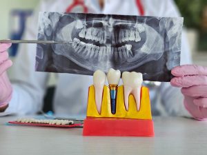 抜歯即時インプラント リスク