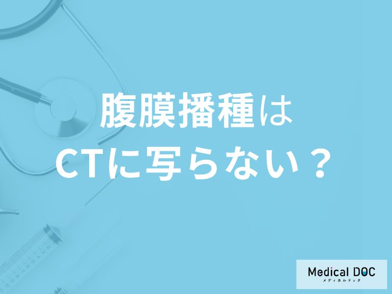 「腹膜播種はCT検査」では写らない？その理由と検査方法を医師が解説！
