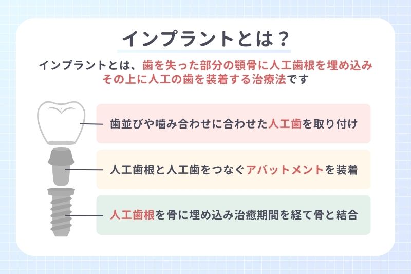インプラントとは？