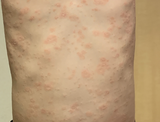 梅毒の進行と鼻以外の症状