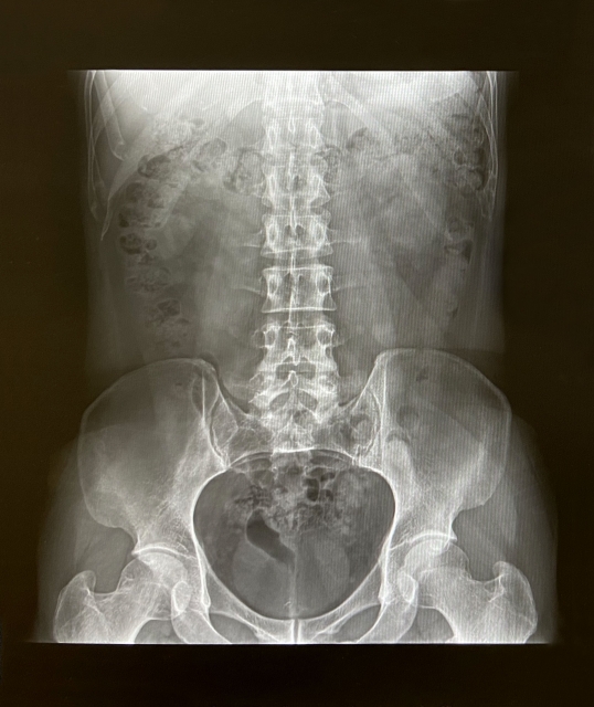 胃結腸反射のメカニズムと自覚症状