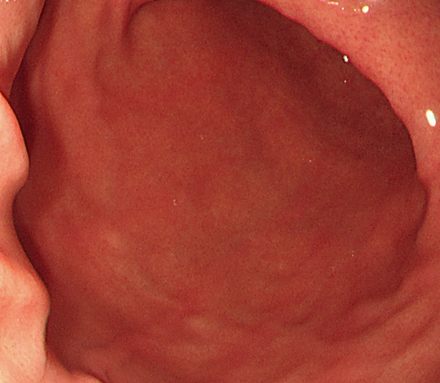 胃結腸反射に問題があるときに生じる弊害