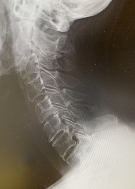 頚椎症の基礎知識