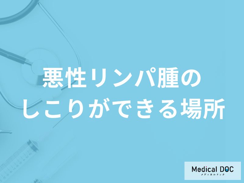 「悪性リンパ腫のしこりができる場所」はご存知ですか?【医師監修】