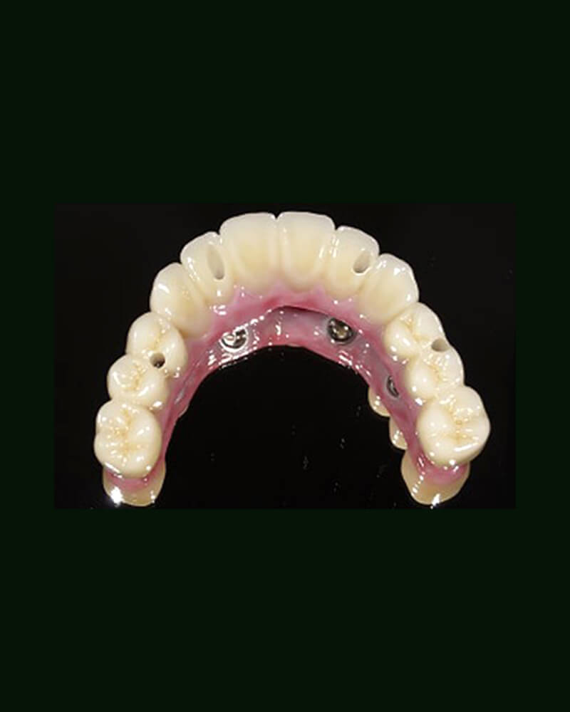 入れ歯の悩みを根本解決。噛む力を取り戻すインプラントの可能性