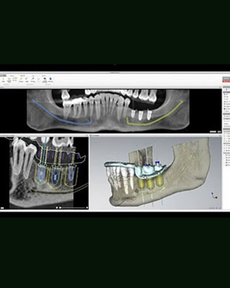 初診からアフターケアまで一人ひとりに寄り添うインプラント治療
