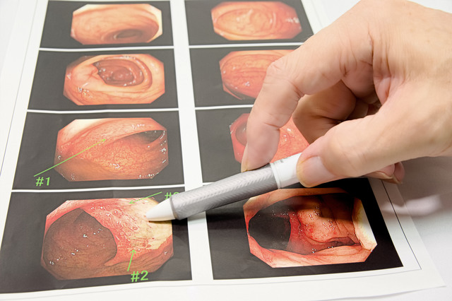 まずは知っておきたい！ 内視鏡検査の重要性