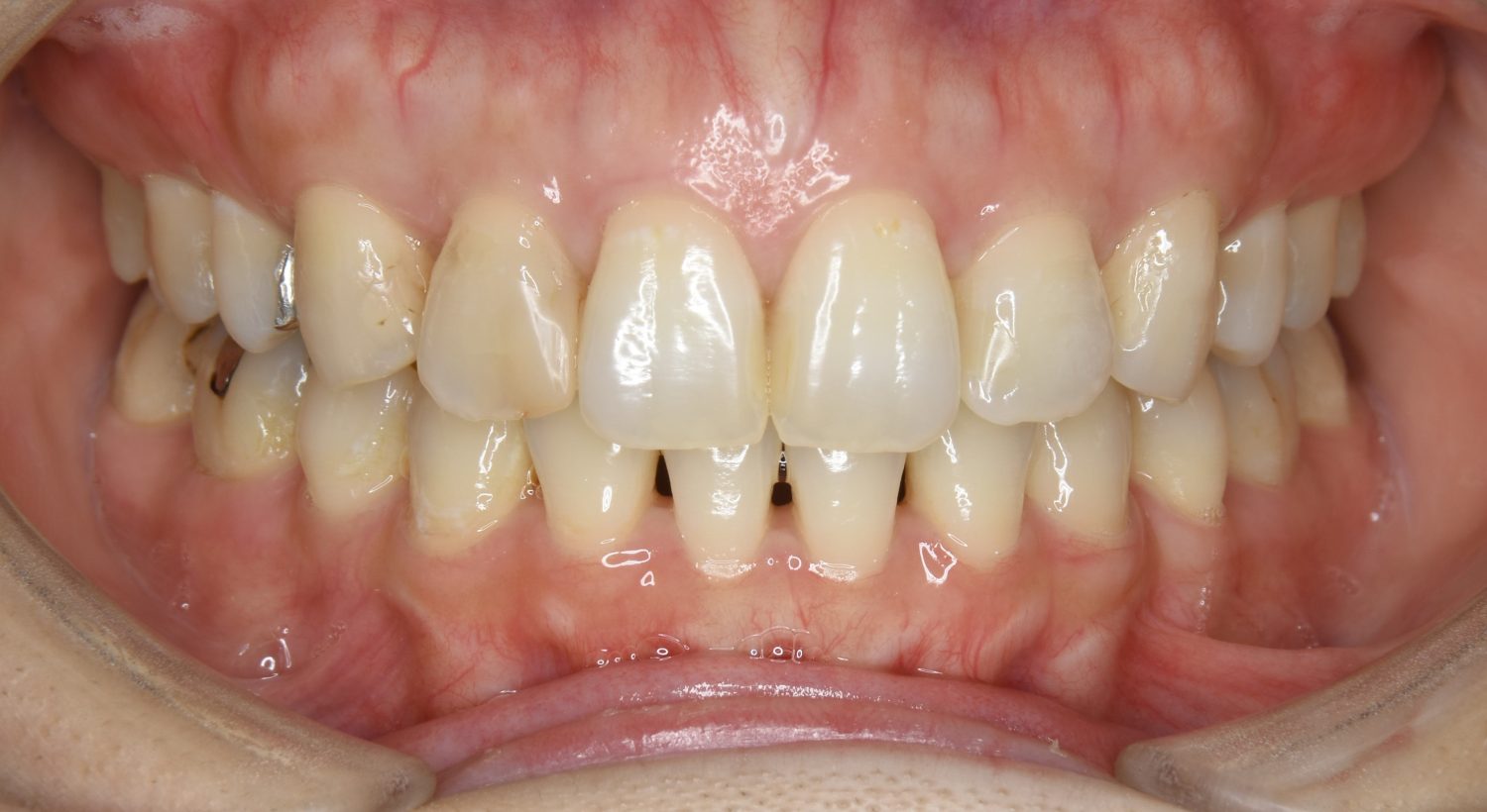 ピーススマイル矯正歯科 上下顎前突② after 正面