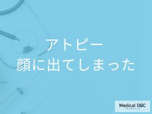 「顔にアトピー」ができるとどんな症状が現れるかご存知ですか？【医師監修】