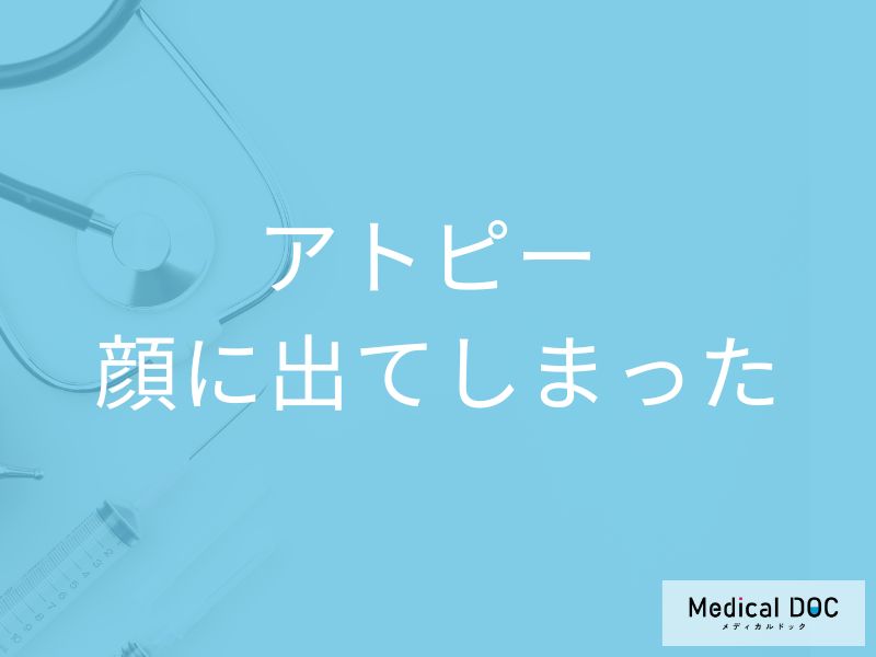 「顔にアトピー」ができるとどんな症状が現れるかご存知ですか？【医師監修】