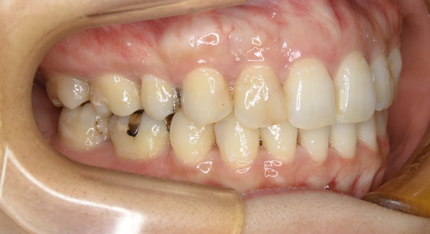 ピーススマイル矯正歯科 上下顎前突② after 右側