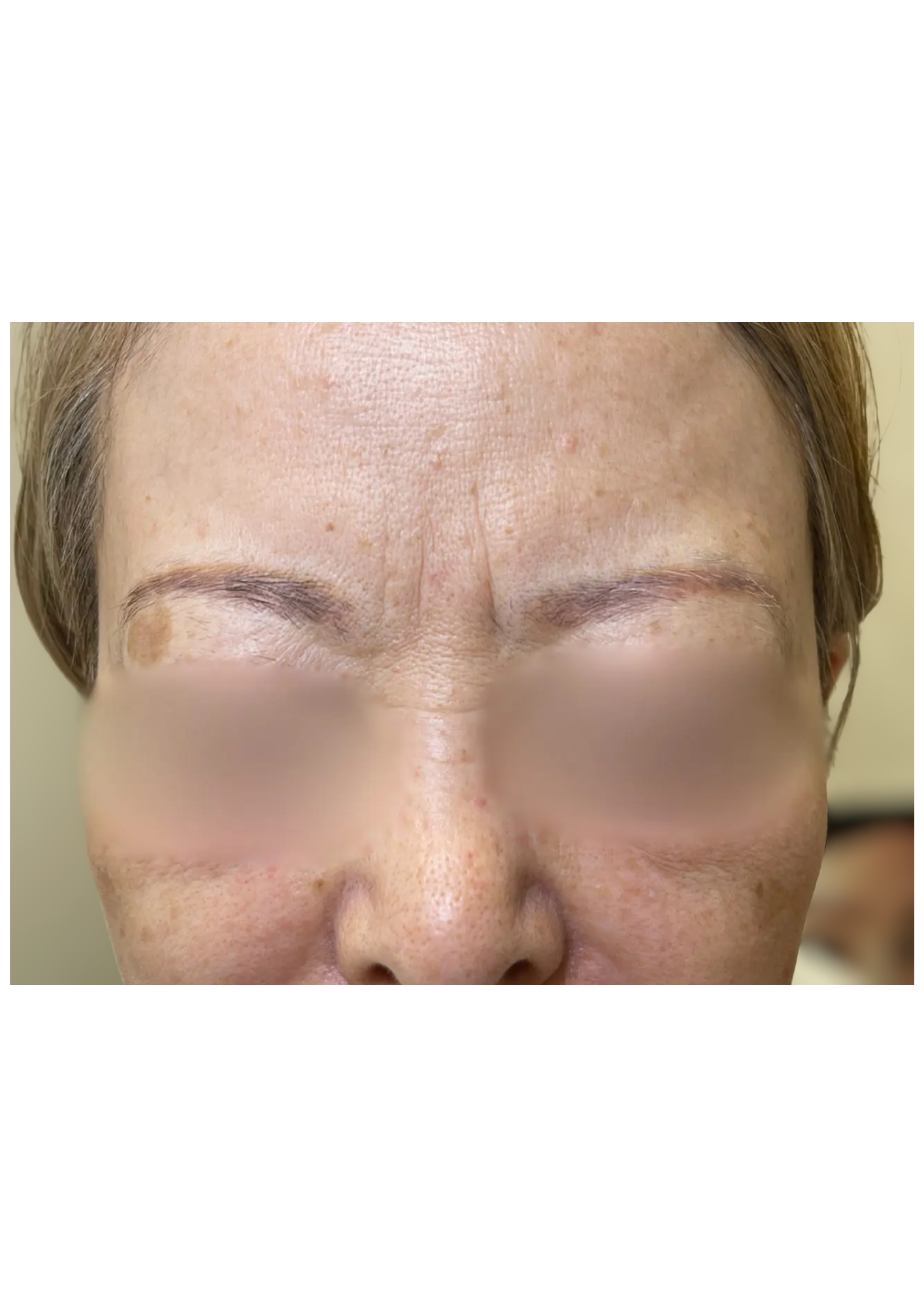 牧田医院・ピコスポット取り放題＋ガウディスキンセラピューティック1・before・正面