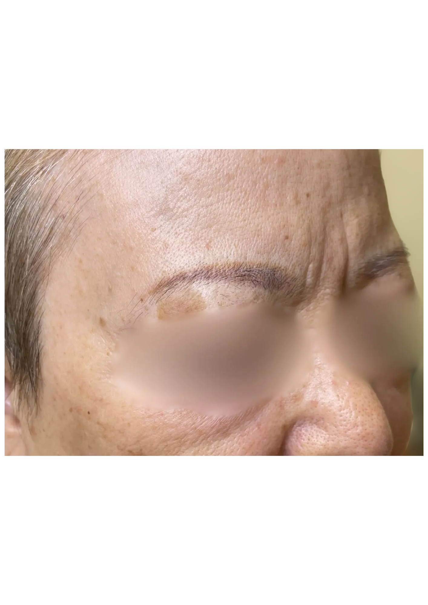 牧田医院・ピコスポット取り放題＋ガウディスキンセラピューティック①・before・右側