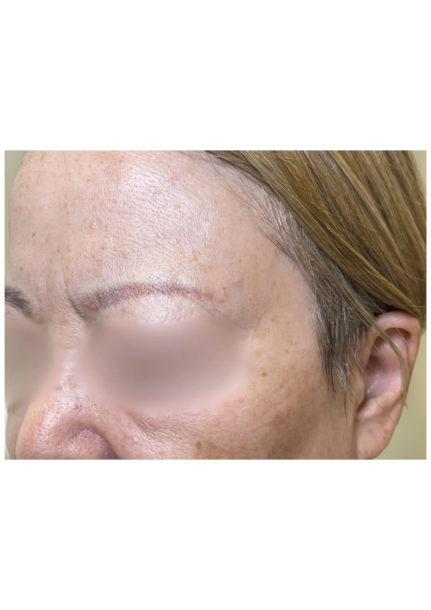 牧田医院・ピコスポット取り放題＋ガウディスキンセラピューティック①・before・左側