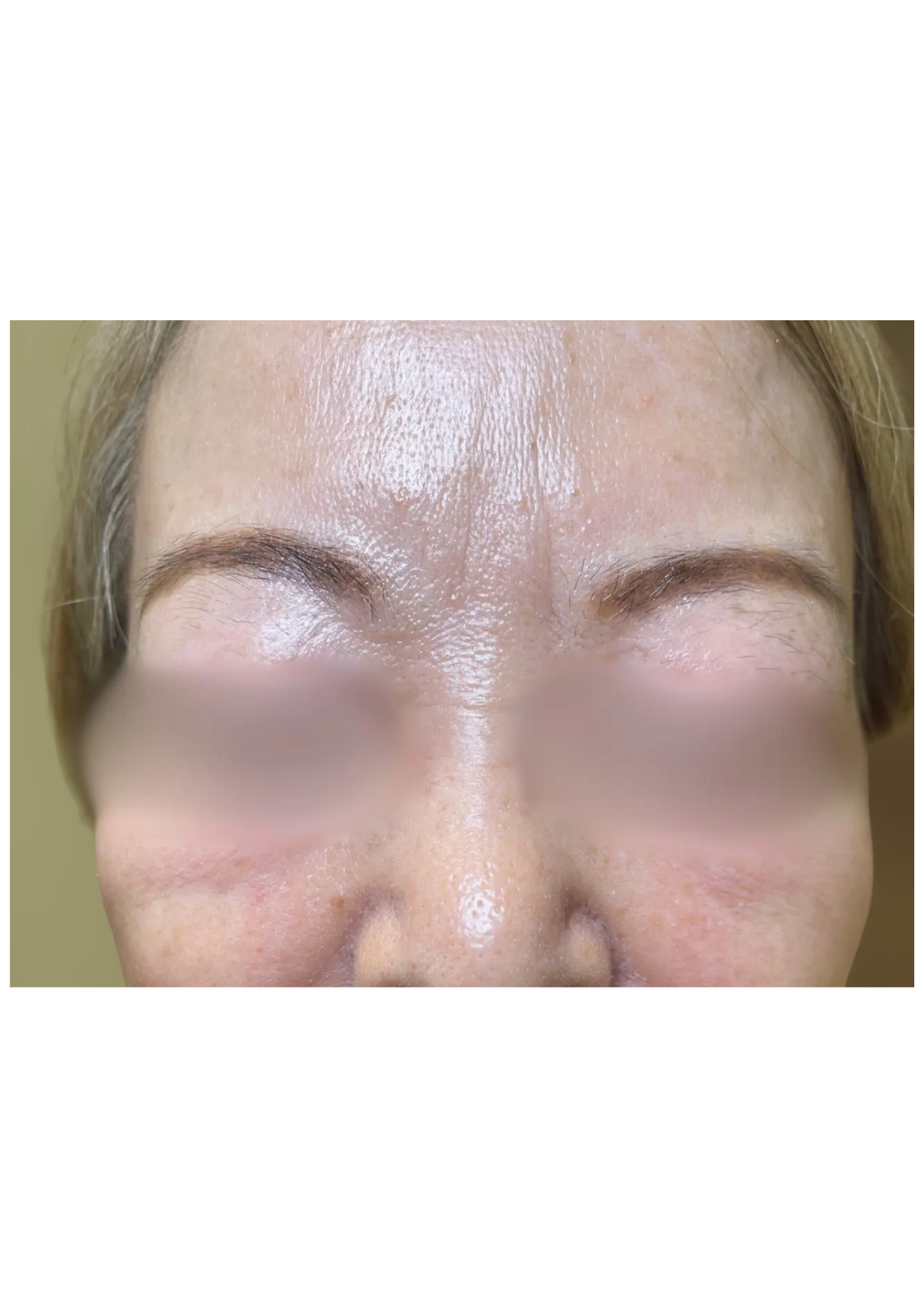 牧田医院・ピコスポット取り放題＋ガウディスキンセラピューティック①・after・正面